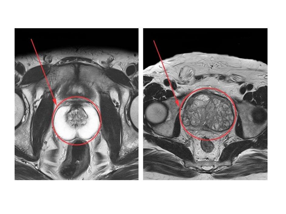 Порівняння здорової (ліворуч) та запаленої (праворуч) простати на МРТ-знімках
